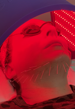 acupuncture face lift red light therapy